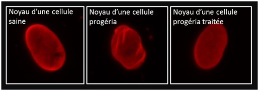 Observation de l’amélioration de noyaux de cellules progéria traitées à la metformine (marquage de la lamine A en rouge)